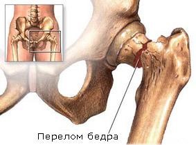 Остеопопроз под микроскопом